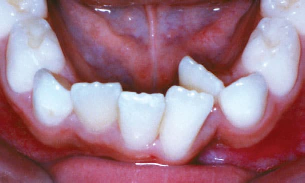 Crowding orthodontic condition treated at Stone Oak Orthodontics Stone Oak Office and Dominion Office in San Antonio TX