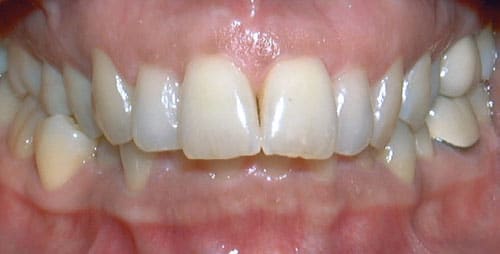 Overbite orthodontic condition treated at Stone Oak Orthodontics Stone Oak Office and Dominion Office in San Antonio TX
