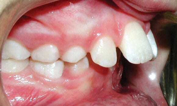 Upper front teeth protrusion orthodontic condition treated at Stone Oak Orthodontics Stone Oak Office and Dominion Office in San Antonio TX