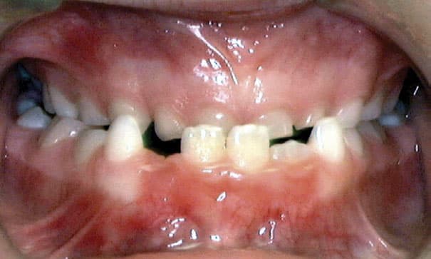 Underbite orthodontic condition treated at Stone Oak Orthodontics Stone Oak Office and Dominion Office in San Antonio TX